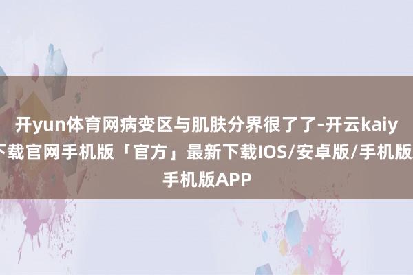 开yun体育网病变区与肌肤分界很了了-开云kaiyun下载官网手机版「官方」最新下载IOS/安卓版/手机版APP